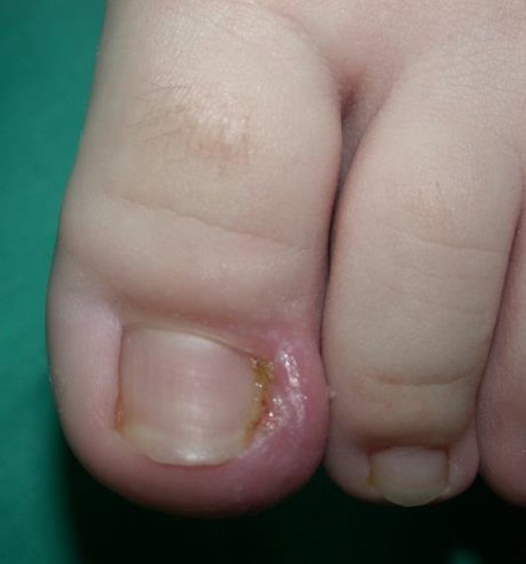 Periungual warts: Pictures, treatment, and prevention