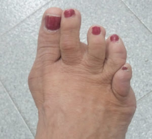 Bunions & Lesser toe deformities – Bath Podiatry